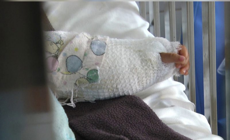 Emiten recomendaciones para evitar quemaduras en niños