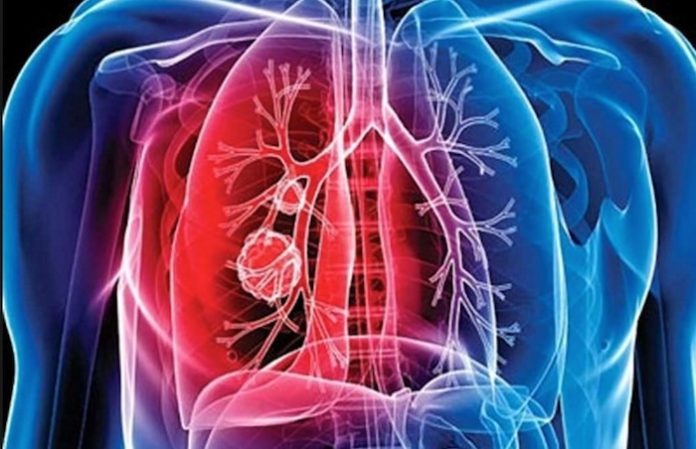 Ministerio de Salud mantiene acciones contra la tuberculosis en Retalhuleu