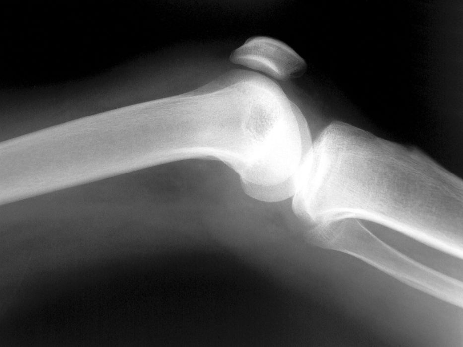 La médula ósea está implicada en el desarrollo de la aterosclerosis