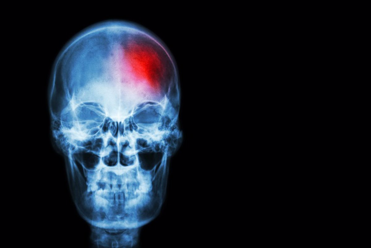 El ictus cerebral mata las neuronas mediante ondas eléctricas letales
