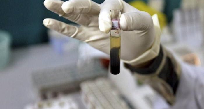 Investigan origen de hepatitis aguda