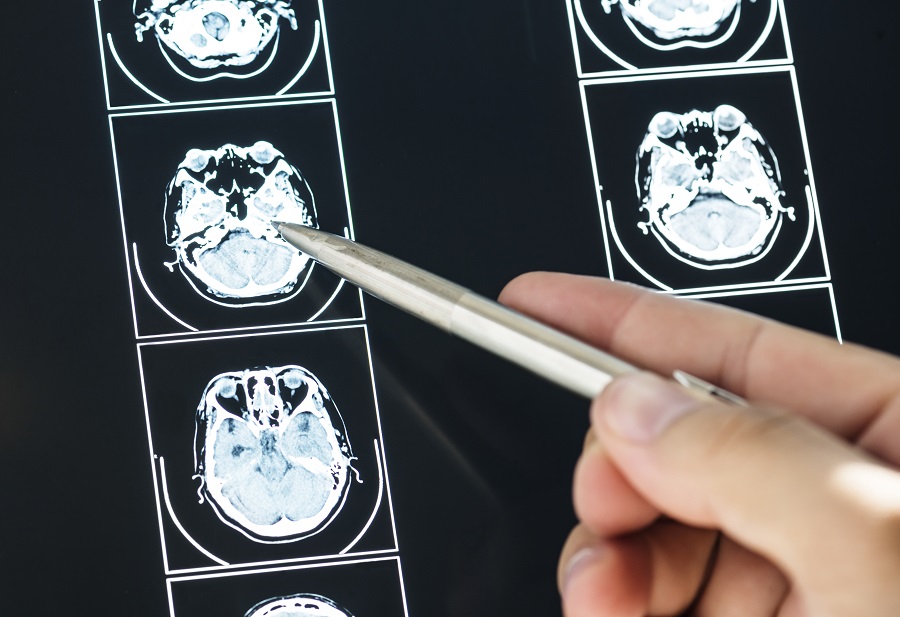 Salud detalla cómo identificar los tumores cerebrales.