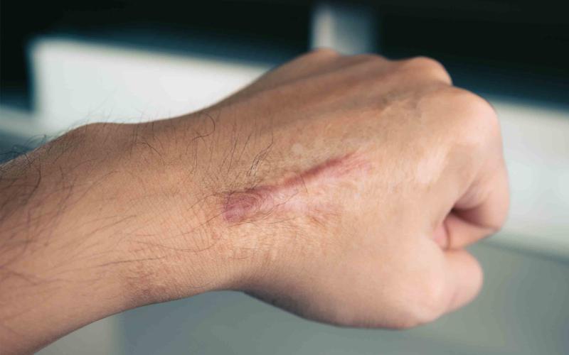 Conozca las señales para identificar la piel queloide