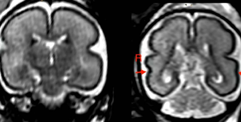 Beber en el embarazo, incluso poco, produce cambios en el cerebro del bebé