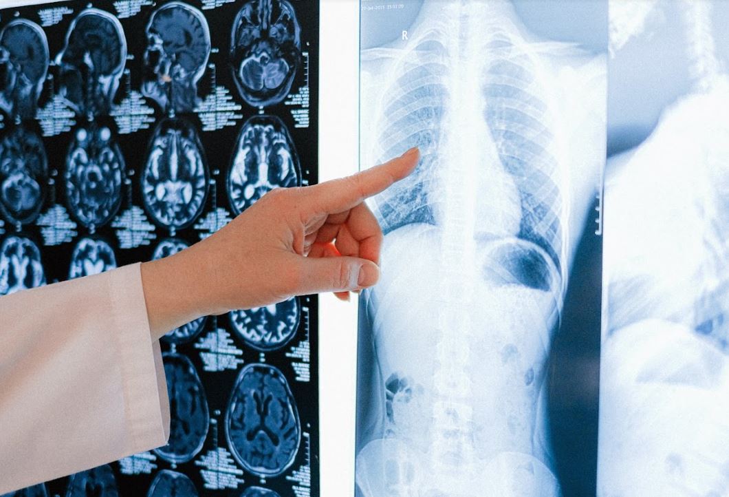 Hacen un llamado a prevenir enfermedad pulmonar obstructiva crónica