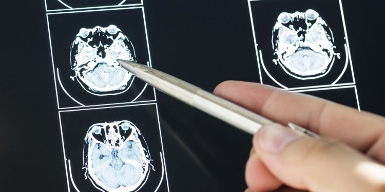 Logran que la quimioterapia penetre en el cerebro contra un tumor mortal