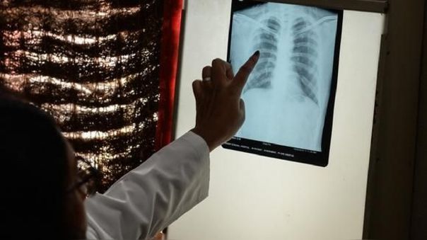 Conforman red pediátrica de tuberculosis en el país