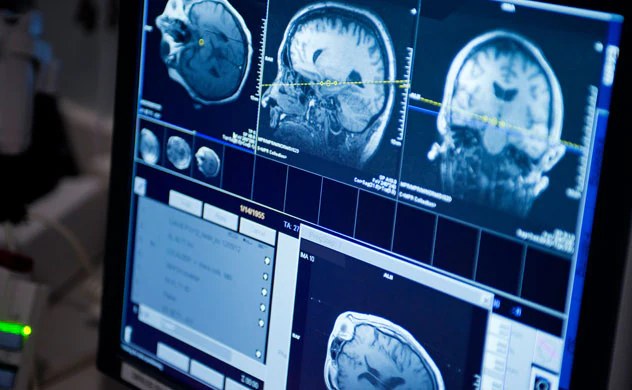 Herramienta de IA analiza el ADN del cáncer cerebral durante cirugía
