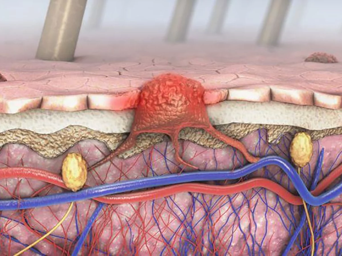 Combinar dos fármacos ayuda a prolongar la vida de pacientes con melanoma metastásico