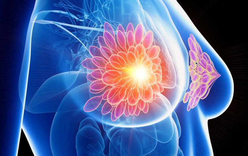 Investigan nueva terapia contra el cáncer de mama. / Foto: Bagó.