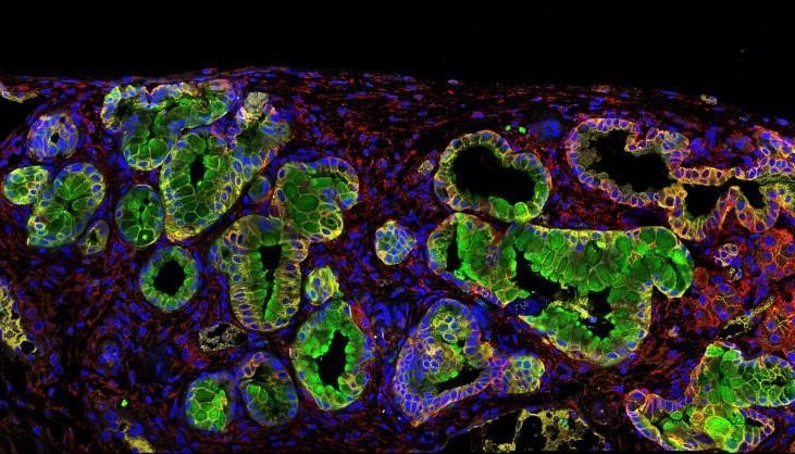 Proteína antibacteriana sería posible diana contra el cáncer de páncreas