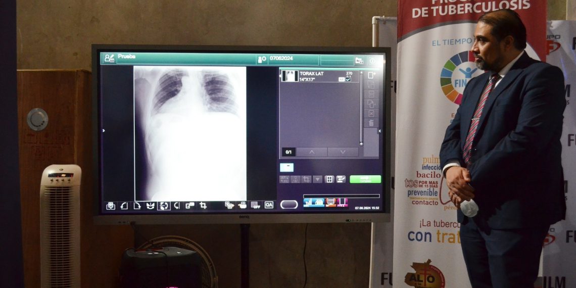 La OMS destaca la importancia de haber recuperado la capacidad de diagnóstico de la tuberculosis.