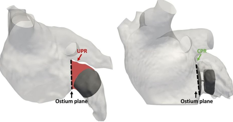 Gemelos digitales digitales del corazón para simular cirugías y establecer escenarios en pacientes con arritmias.