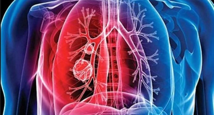 Cada 24 de marzo se celebra el día Mundial de la Tuberculosis. (Foto: archivo)