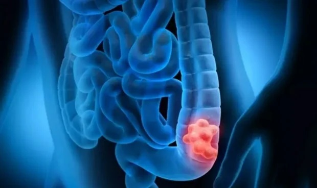 Demuestran que la inmunoterapia es eficaz contra el cáncer colorrectal es uno de los más mortales.