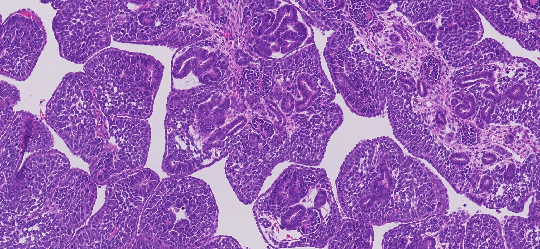 Alteraciones genéticas del cáncer renal infantil abren la puerta a nuevos tratamientos