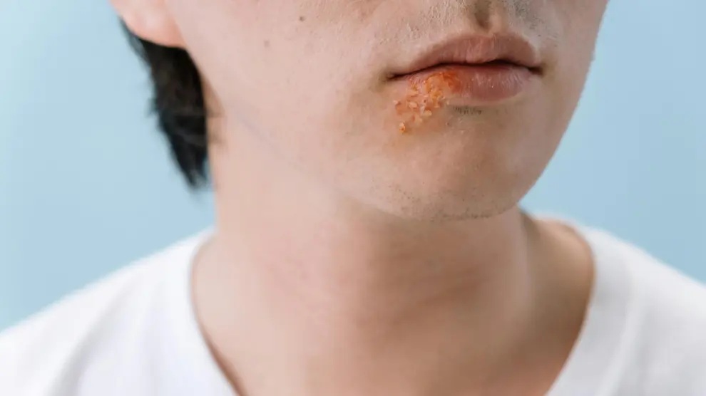 Estudio asocia el herpes labial a más propensión a desarrollar alzhéimer