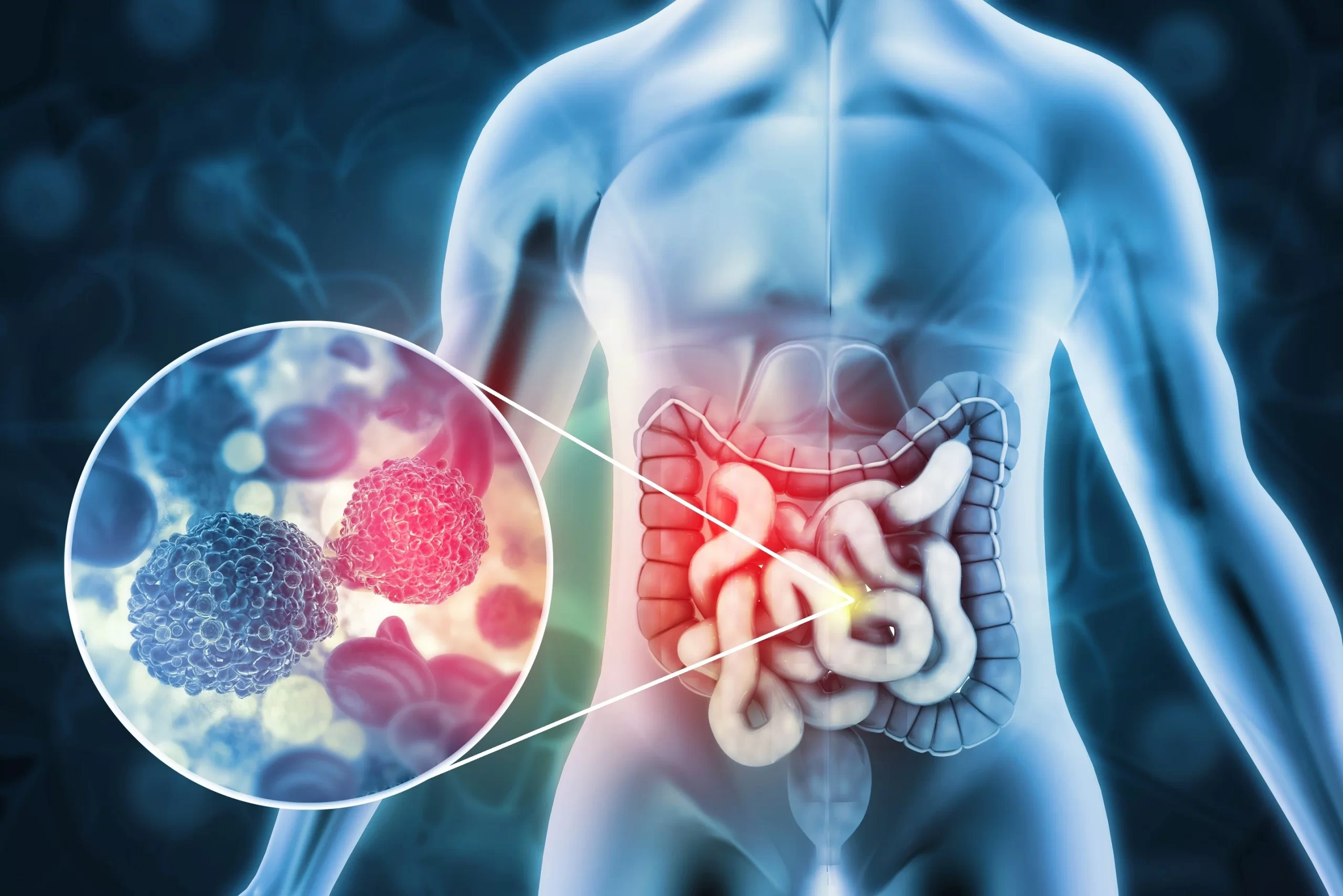 Biopsia líquida detecta el cáncer colorrectal en fase inicial con un 95 % de éxito