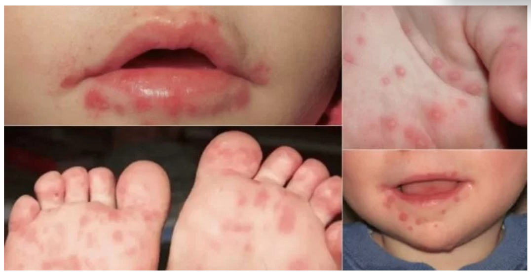 La transmisión ocurre a través de secreciones respiratorias, saliva, líquido de las ampollas, heces o por contacto con objetos contaminados, como cubiertos y juguetes. / Foto: MSPAS