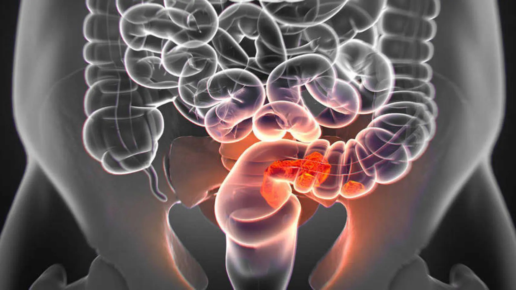 El cáncer colorrectal se diagnostica en menores de 50 años suele detectarse en fases avanzadas.
