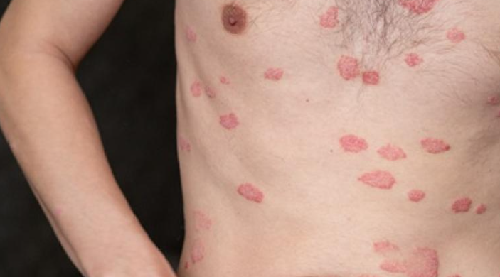 Especialista comparte recomendaciones ante la enfermedad tropical “Leishmaniasis”. (Foto : MSPAS)