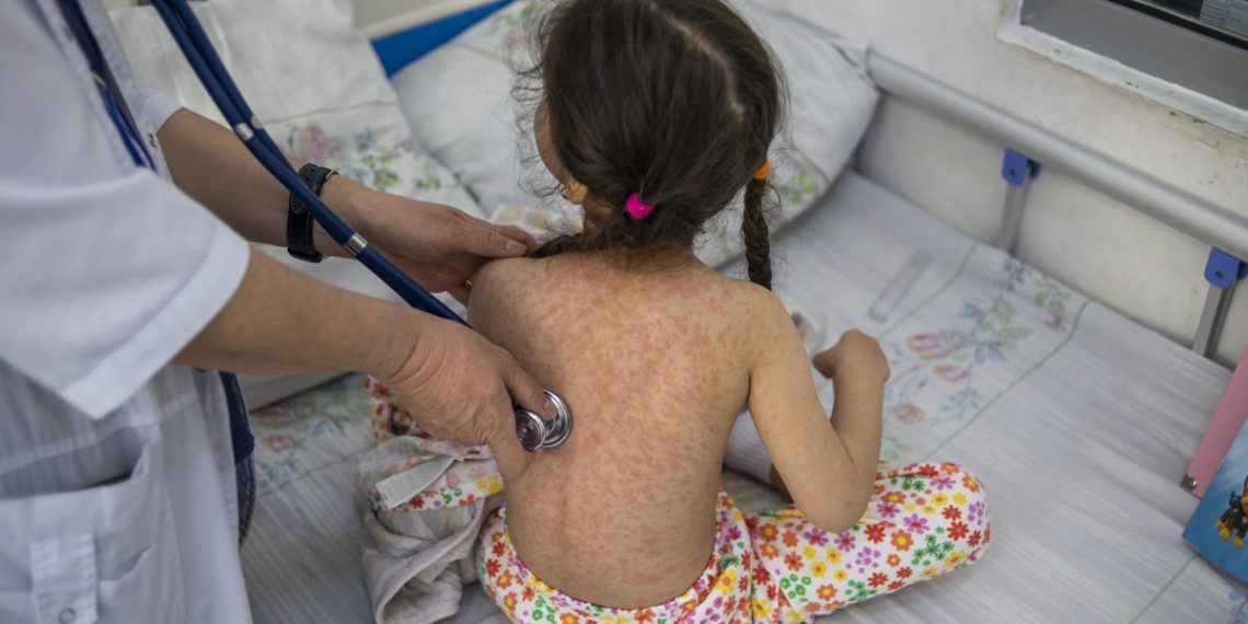 Ministro de Salud insta a retomar hábitos de vacunación ante brote de sarampión